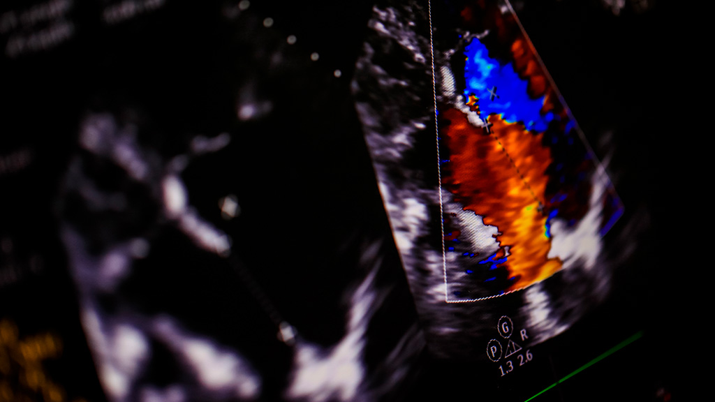 Ultrasonido Doppler Color Bazo