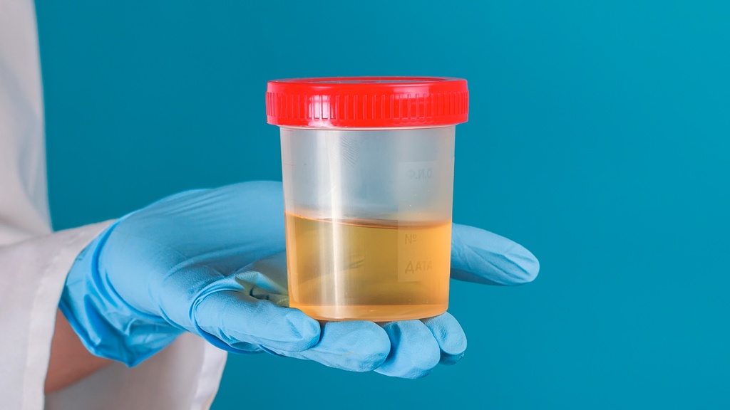 Fósforo en Orina Ocasional