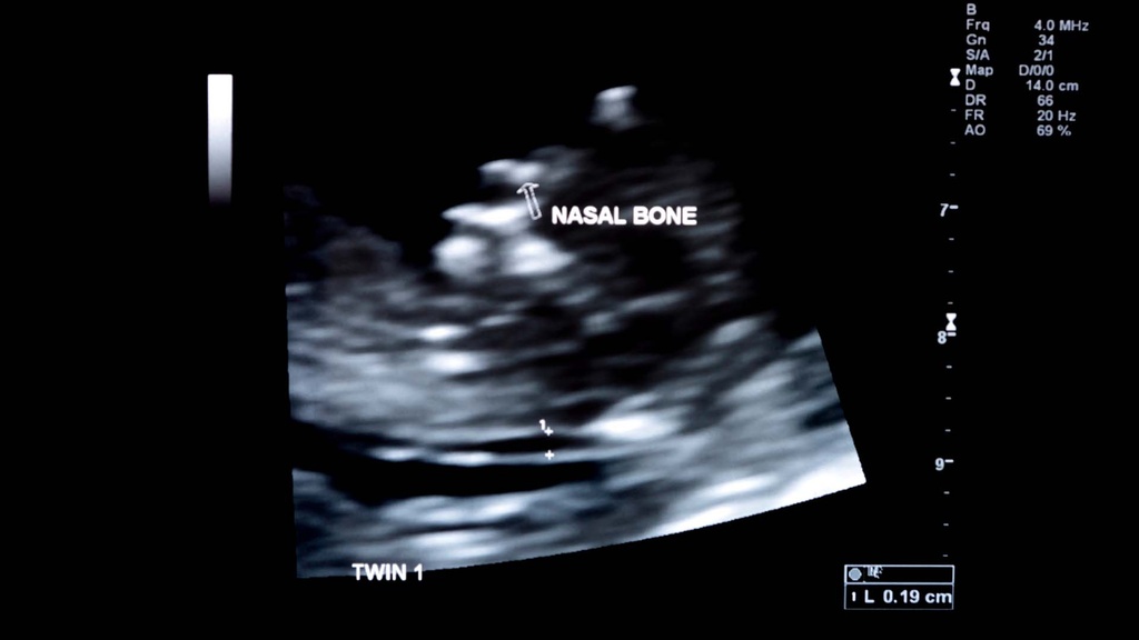 Ultrasonido Hueso Nasal