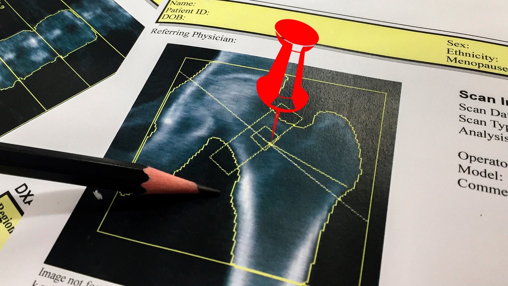 Densitometría Cadera Ortopédica