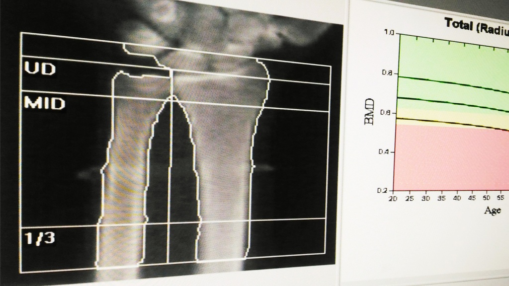 Densitometría de Mano