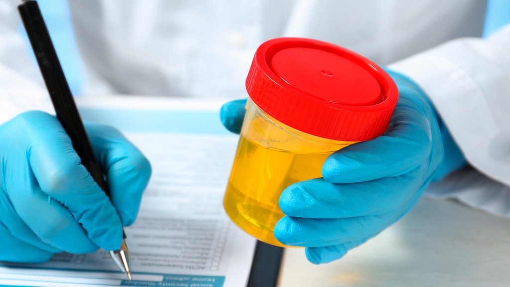 Glucosa en Orina Ocasional