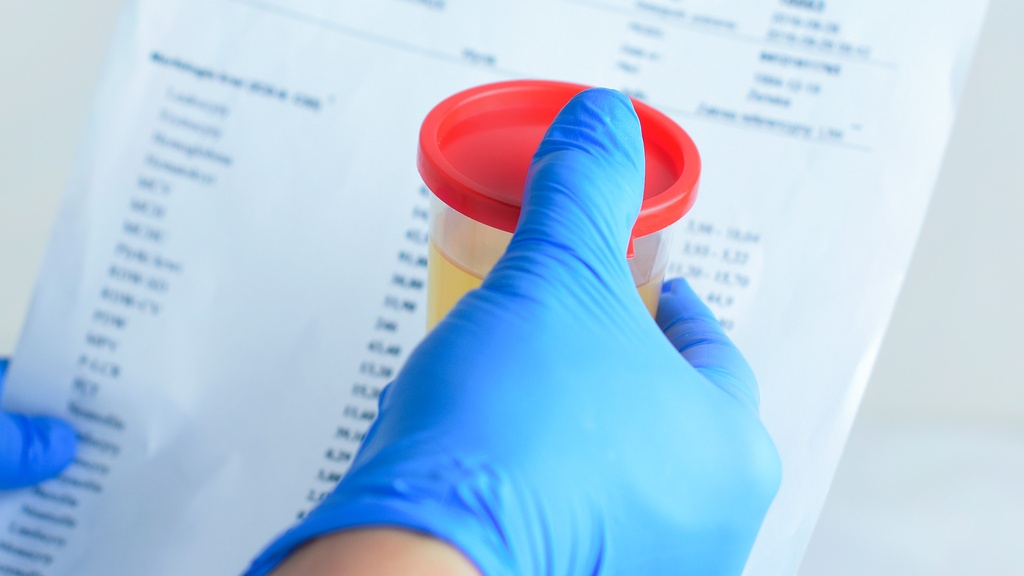 Nitrógeno de Urea en Orina de 24 h