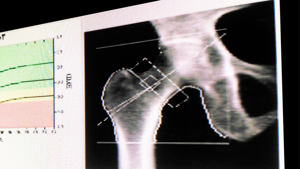 Densitometría de Fémur Proximal Izq. Der. (Cadera)
