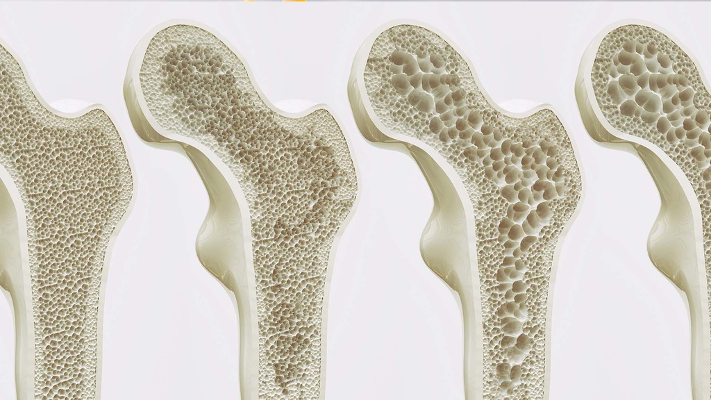 Perfil de Osteoporosis