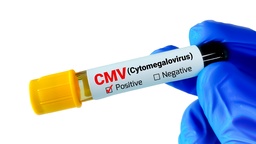 [ACACIM] Ac. Anti - Citomegalovirus IgM