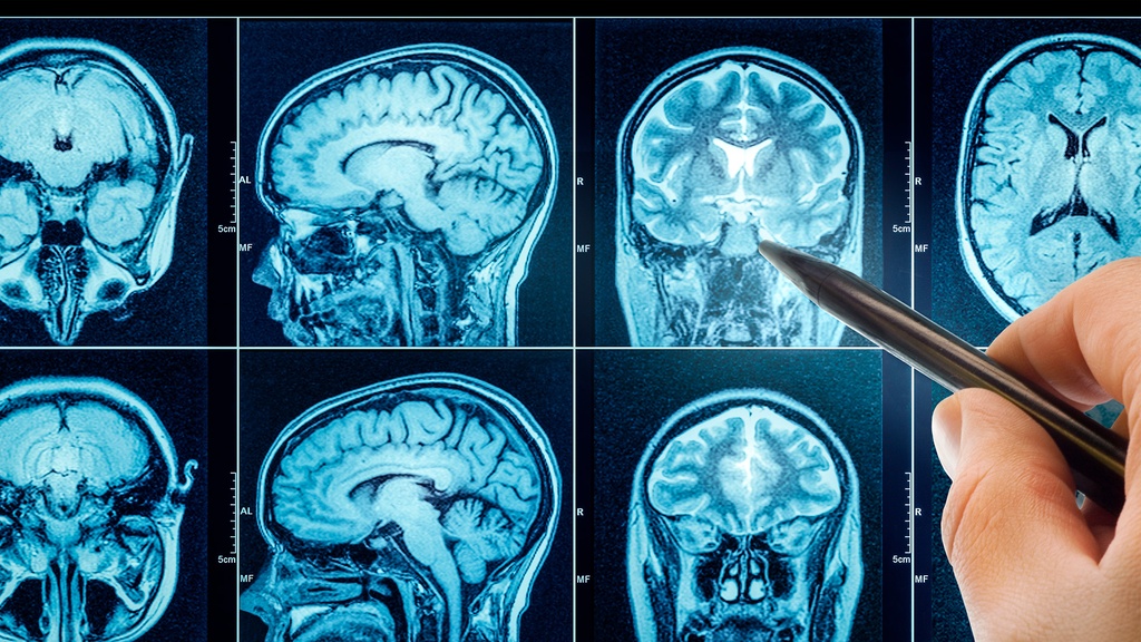 Resonancia Magnética Union Craneo Cervical Con Contraste
