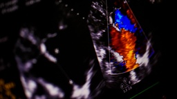 [USDCHI] Ultrasonido Doppler Color Higado